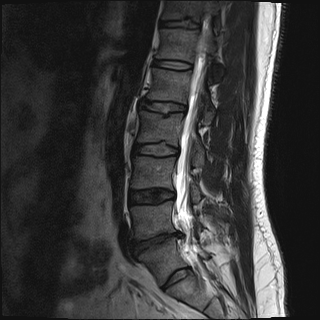image billy spine mri 2019